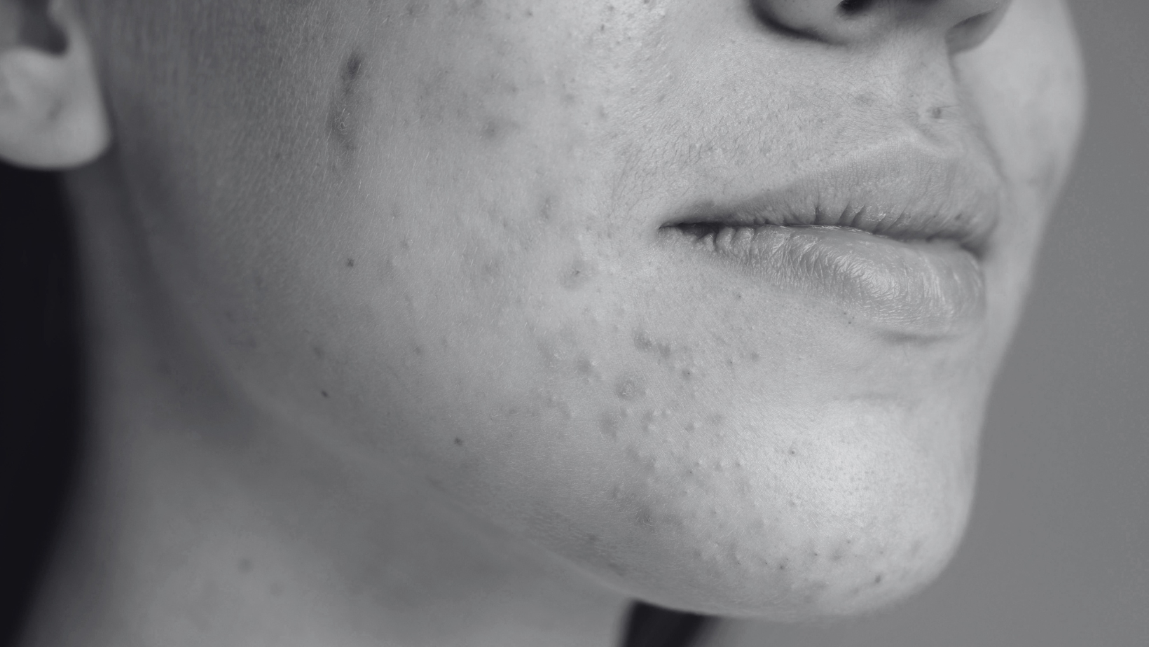 Lo que debes de saber sobre el acné en las pieles más jóvenes