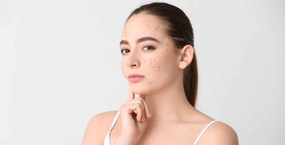 El acné tiene muchas causas; ninguna es tu culpa