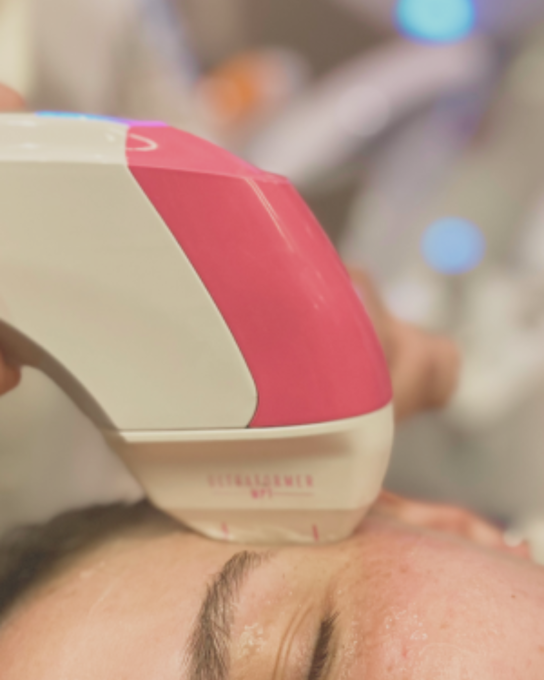  Ultraformer MPT Tratamiento