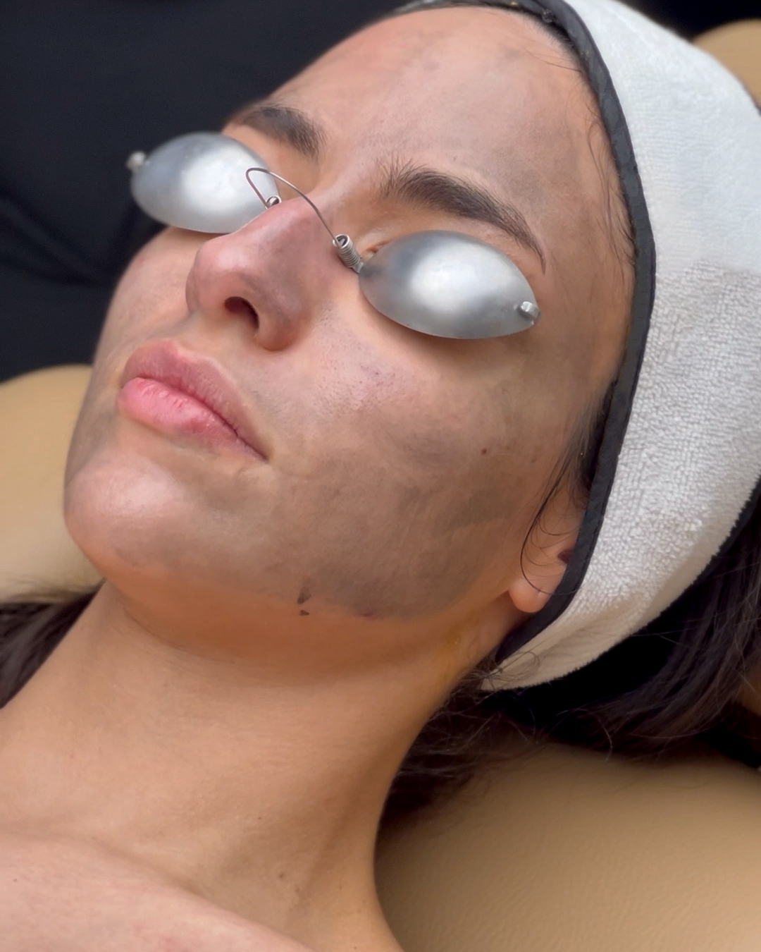  Hollywood Peel Tratamiento