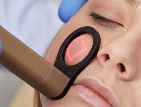  Smart Pico Fraccionado Cara Tratamiento